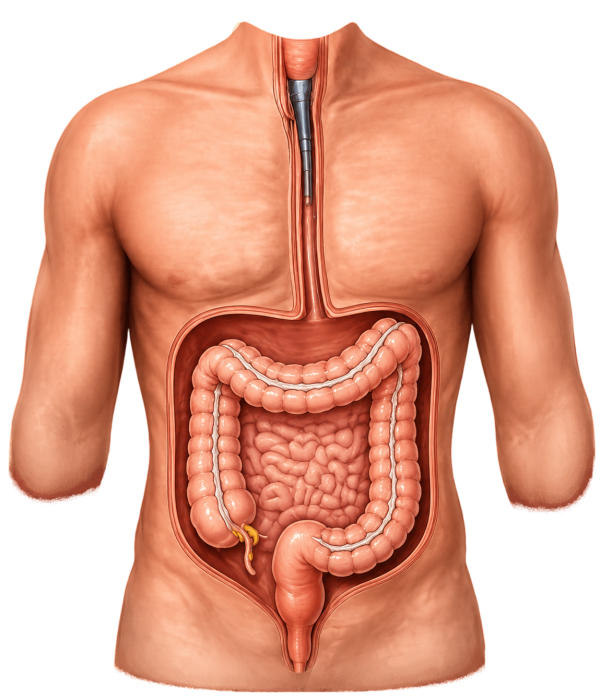 Anal Fissure
