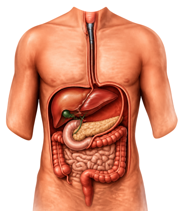 Bile Duct Stones