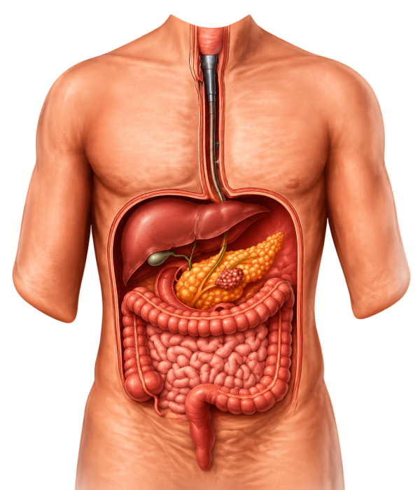 Chronic Pancreatitis