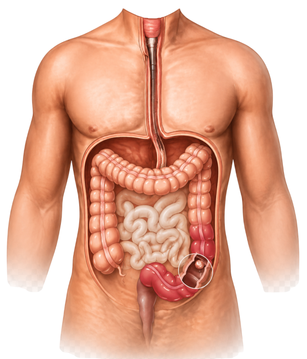 Colorectal Cancer