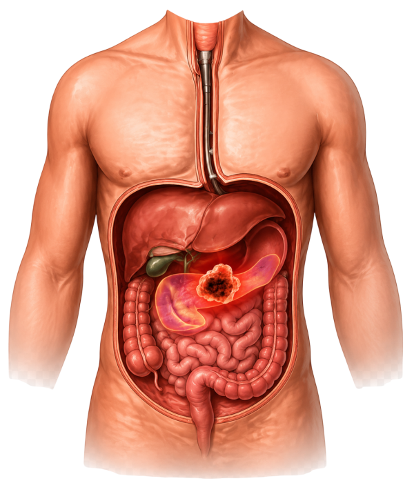Pancreatic Cancer