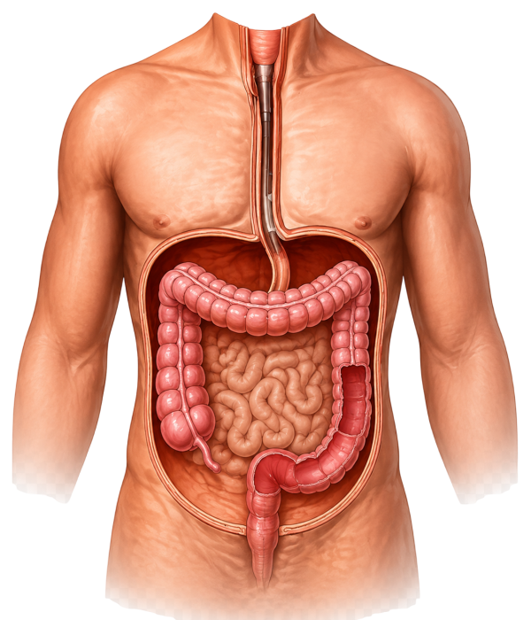 Ulcerative Colitis